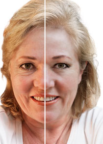 Before and after photo of Botox