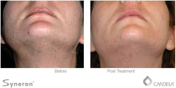 Before and after photo of laser hair removal on the neck and chin area