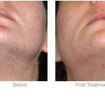 Before and after photo of laser hair removal on the neck and chin area