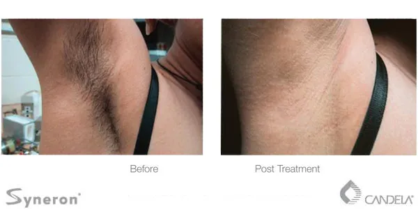Before and after photo of laser hair removal on the armpit area