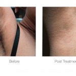 Before and after photo of laser hair removal on the armpit area