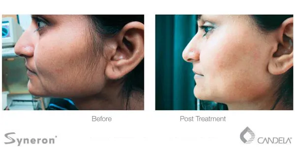 Before and after photo of laser hair removal on the side of the face