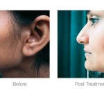 Before and after photo of laser hair removal on the side of the face