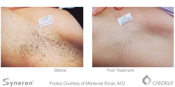 Before and after photo of laser hair removal on the armpit area
