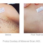 Before and after photo of laser hair removal on the armpit area