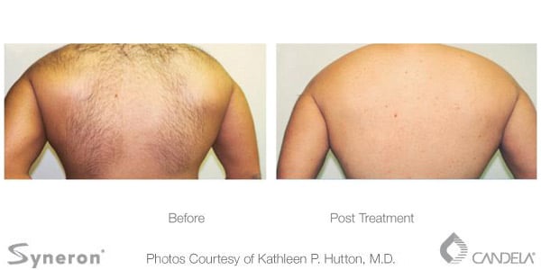 Before and after photo of laser hair removal on the back