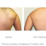Before and after photo of laser hair removal on the back