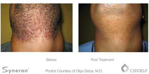 Before and after photo of laser hair removal on the neck and chin area