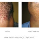 Before and after photo of laser hair removal on the neck and chin area