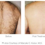 Before and after photo of laser hair removal on the back