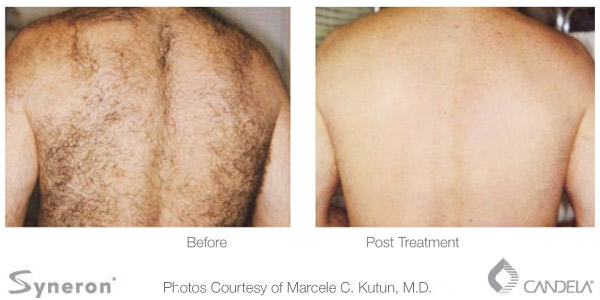 Before and after photo of laser hair removal on the back