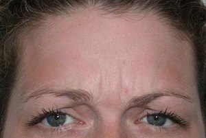 Botox With Nizar Merheb MD