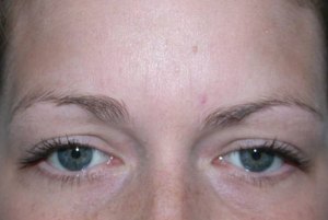 Botox With Nizar Merheb MD