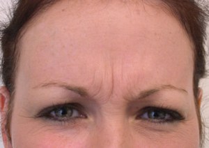 Botox With Nizar Merheb MD