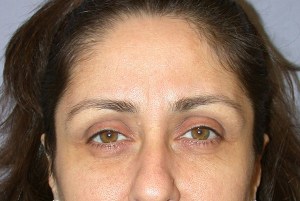 Botox With Nizar Merheb MD