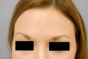 Botox With Nizar Merheb MD