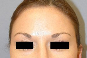 Botox With Nizar Merheb MD