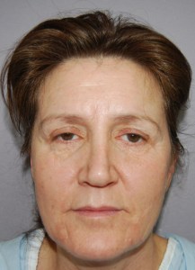 Brow lift With Nizar Merheb MD