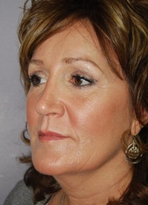 Brow lift With Nizar Merheb MD
