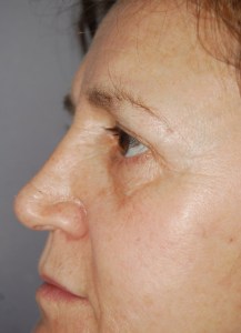 Brow lift With Nizar Merheb MD