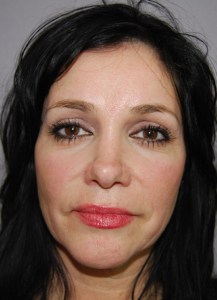Brow lift With Nizar Merheb MD