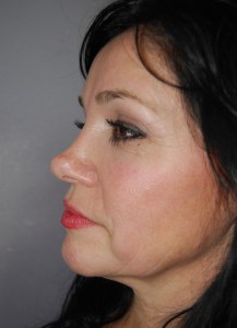 Brow lift With Nizar Merheb MD