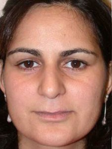 Brow lift With Nizar Merheb MD