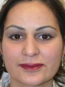 Brow lift With Nizar Merheb MD