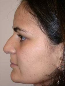 Brow lift With Nizar Merheb MD