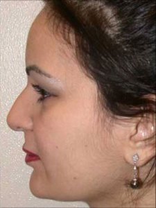 Brow lift With Nizar Merheb MD