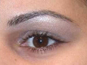 Brow lift With Nizar Merheb MD