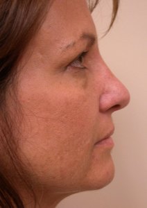 Brow lift With Nizar Merheb MD