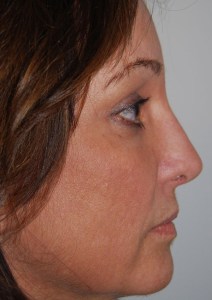 Brow lift With Nizar Merheb MD