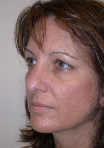 Brow lift With Nizar Merheb MD