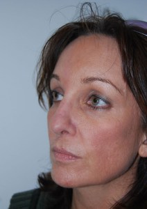 Brow lift With Nizar Merheb MD
