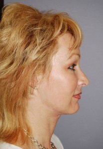 Brow lift With Nizar Merheb MD