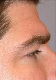 Brow lift With Nizar Merheb MD