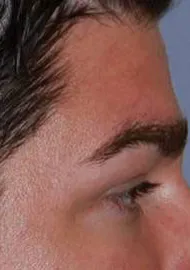 Brow lift With Nizar Merheb MD