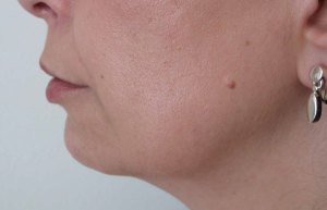 Chin Implants With Nizar Merheb MD