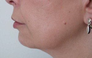 Chin Implants With Nizar Merheb MD