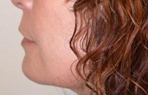 Chin Implants With Nizar Merheb MD