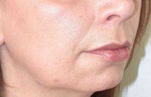 Chin Implants With Nizar Merheb MD