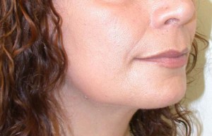 Chin Implants With Nizar Merheb MD