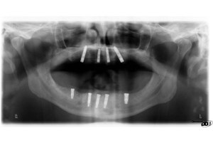 Dental Implants With Nizar Merheb MD