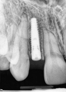 Dental Implants With Nizar Merheb MD