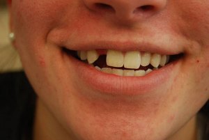 Dental Implants With Nizar Merheb MD