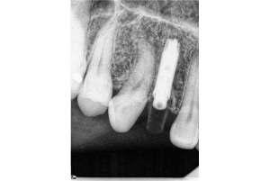 Dental Implants With Nizar Merheb MD