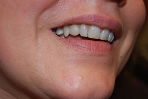 Dental Implants With Nizar Merheb MD