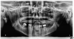 Dental Implants With Nizar Merheb MD