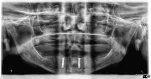 Dental Implants With Nizar Merheb MD
